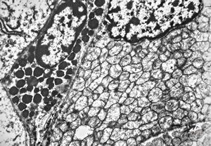 F, 32y. | oncocytic parathyreoideal adenoma